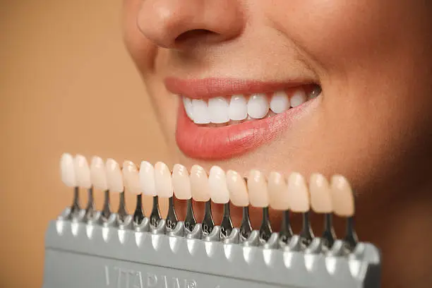 Sorriso perfetto con trattamenti di estetica dentale — Federico Campedelli Dentista
